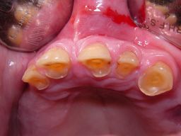 Oberkieferrestz�hne in  Aufsicht