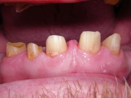 Oberkiefer vorm Zementieren