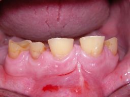 Oberkieferrestzähne von vorne