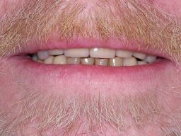 Ästhetikeinprobe, entspannte Oberlippe