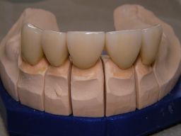 Oberkiefer von vorne