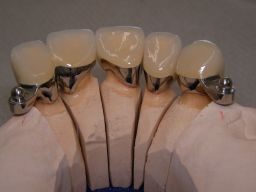 Oberkiefer v. innen, Titankugeln