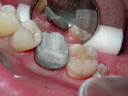 Fertige präendodontische Aufbaufüllung aus Amalgam