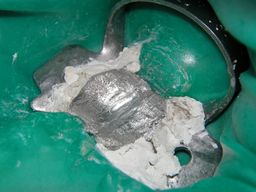 Koronaler Amalgamverschluss nach WKB