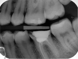 Röntgenbild vor der Behandlung