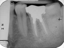 Röntgenbild nach abgeschlossener Behandlung