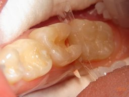 Keramikinlays beim Einsetzen mit Matrize