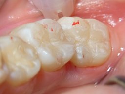 Ergebnis nach Einsetzen der Keramikinlays