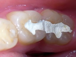 Präparierte Kavitäten mit Guttapercha-Provisorien