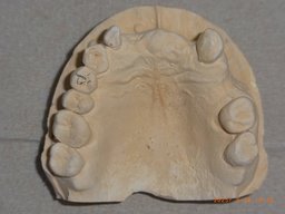 Gipsmodell Oberkiefer Ausgangssituation