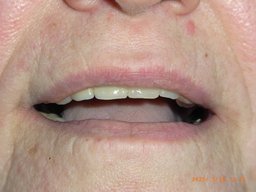 Ergebnis mit eingesetzter Teleskopprothese