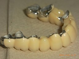 Teleskopprothesen Ober- und Unterkiefer von der Seite