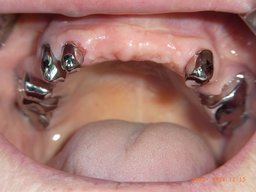 Primärkronen im Mund, Oberkiefer von unten