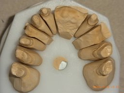 Gesägtes Modell mit Primärkronen und Teleskop-Matrize