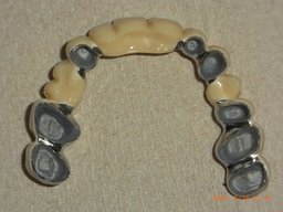 Fertige Teleskopprothese von unten mit Sekundärteleskopen