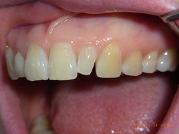 Ausgangssituation Zahn 22 vor dem Veneer