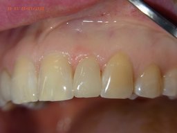 Ergebnis nach Veneer-Einsetzen an Zahn 22