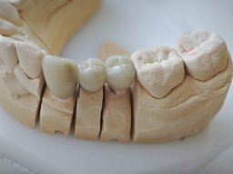 Keramikbrücke auf Sägemodell Kaufläche