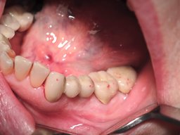 Ergebnis Zahn-Implantatbrücke im Mund