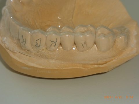 Formteil/Folie auf Modell, Frontzähne, Detail