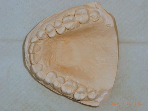 Gipsmodell Oberkiefer, Übersicht