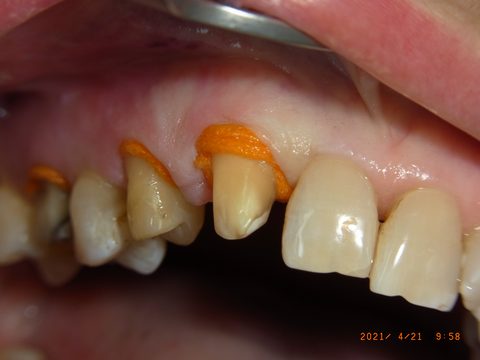 Retraktionsfaden, Nahaufnahme