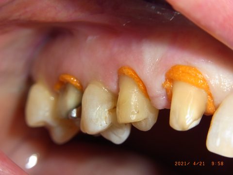 Retraktionsfaden Frontzähne Oberkiefer