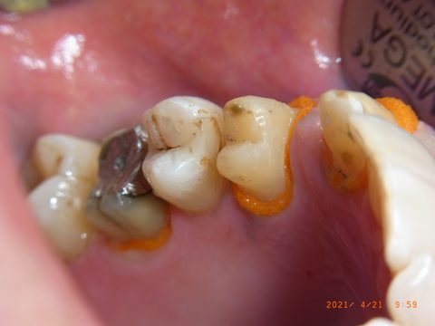 Retraktionsfaden Seitenzähne