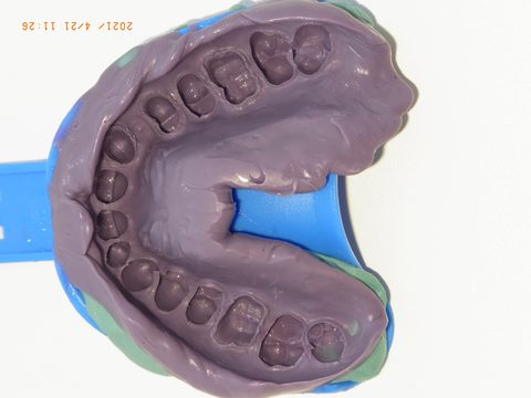 Zweitabformung Oberkiefer, Gesamtansicht