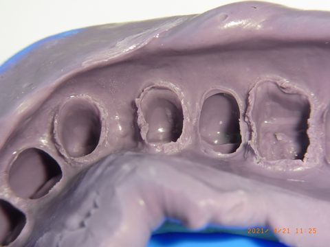 Zweitabformung: Stumpfabformungen, Detail