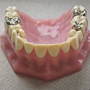 Gesamtansicht Unterkiefermodell, Xiaomi 14 Telemakro