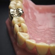 Modell seitlich: Zahn 24 scharf, Tiefenschärfenwirkung auf benachbarte Zähne