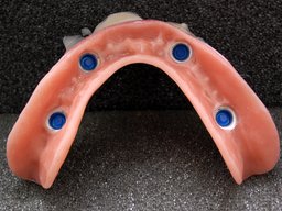 Unterseite der Locatorprothese mit vier blauen Kunststoffmatrizen Locatorprothese Unterseite blaue Matrizen