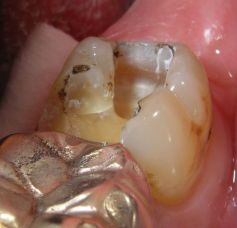 Schmerzhafter Haarriß, mit Amalgam beschwerdefrei