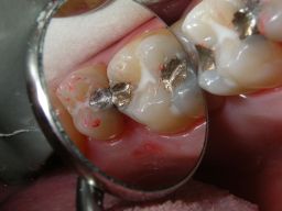 1 frische, 2 ältere Füllungen, Fissurenversiegler