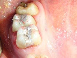 Mittelgroße und große Amalgamfüllung